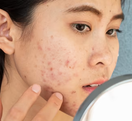 Here’s Why Misusing Acne Medications Might Make Your Body Resistant To Antibiotics