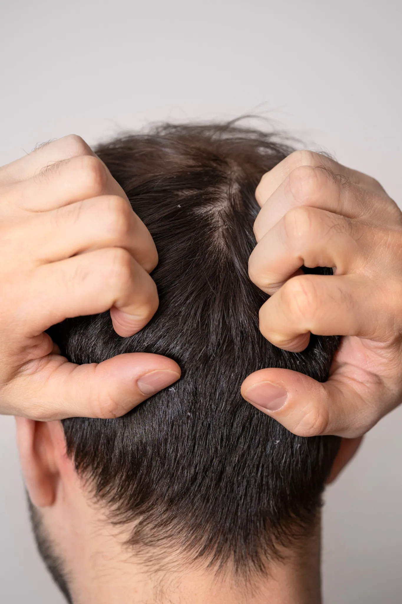 A man scratching his scalp, showing visible dandruff in his hair | Shine Dermatology's Hair Treatment