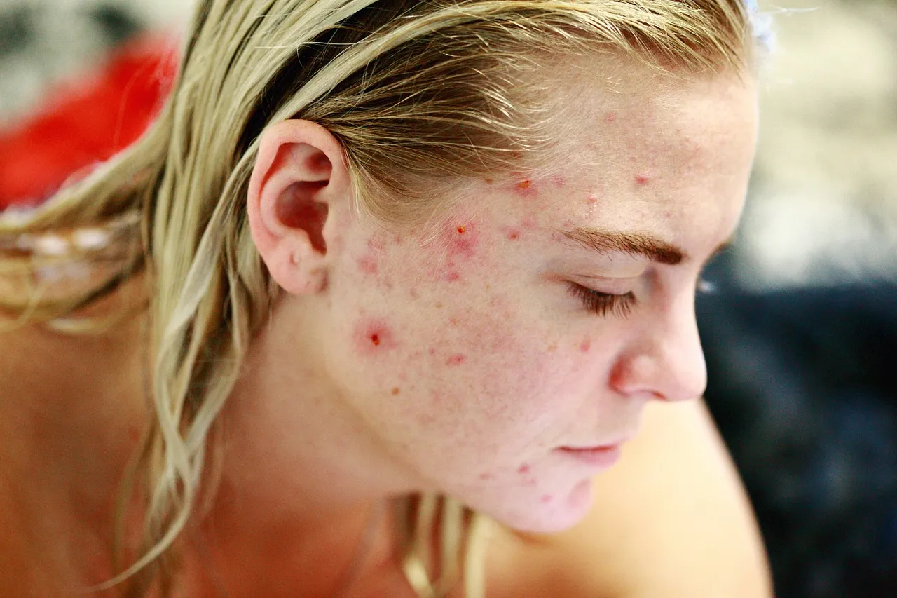 Close-up of a blonde woman with red, inflamed acne on her cheeks, jawline, and forehead | Shine Dermatology