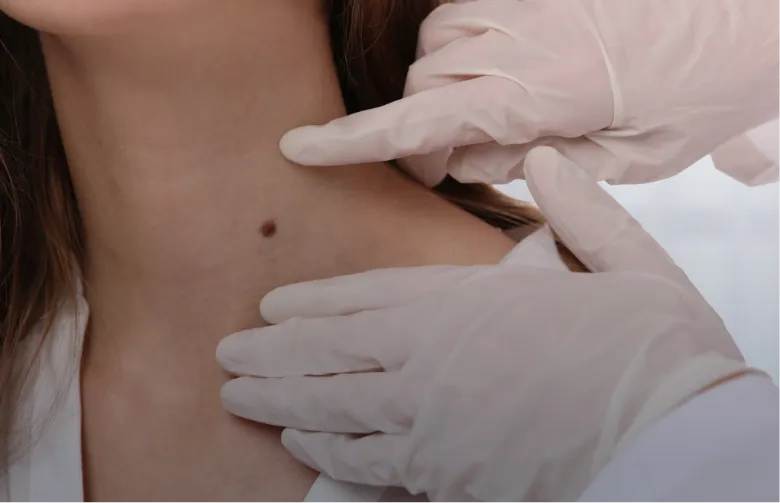 Woman with a mole on her neck being examined by a gloved practitioner | Shine Dermatology