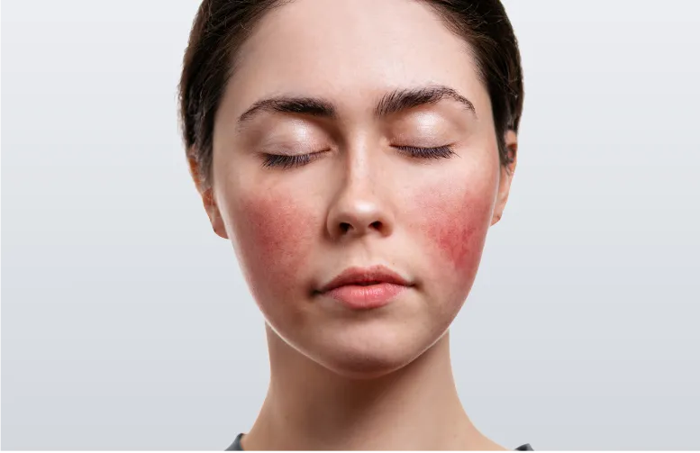 Red face caused by Rosacea